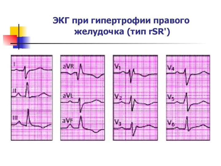 ЭКГ при гипертрофии правого желудочка (тип rSR')