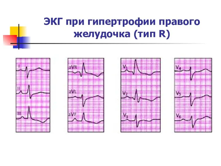 ЭКГ при гипертрофии правого желудочка (тип R)