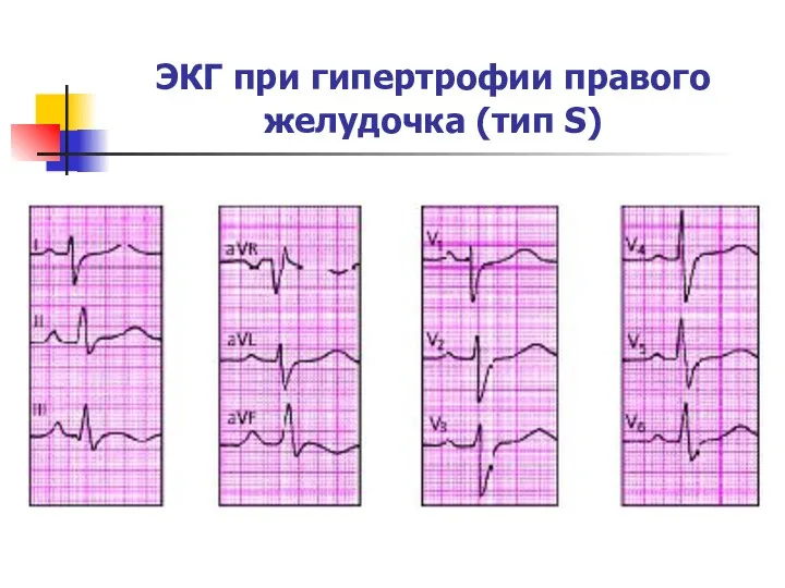 ЭКГ при гипертрофии правого желудочка (тип S)