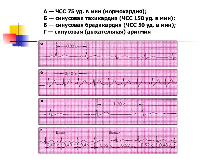 А — ЧСС 75 уд. в мин (нормокардия); Б —