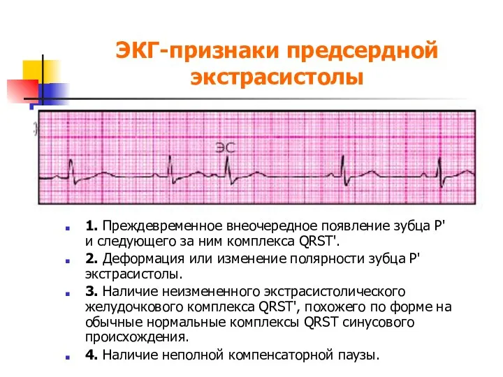 ЭКГ-признаки предсердной экстрасистолы 1. Преждевременное внеочередное появление зубца P' и