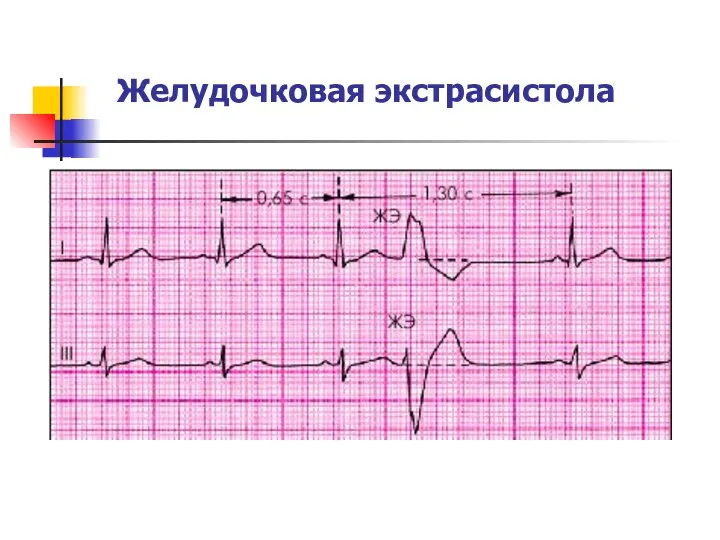 Желудочковая экстрасистола