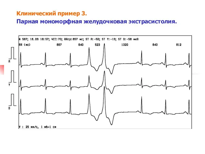 Клинический пример 3. Парная мономорфная желудочковая экстрасистолия.