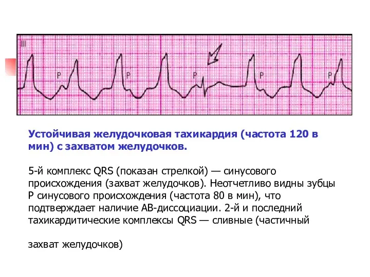 Устойчивая желудочковая тахикардия (частота 120 в мин) с захватом желудочков. 5-й комплекс QRS