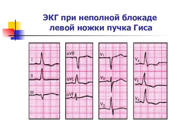 ЭКГ при неполной блокаде левой ножки пучка Гиса