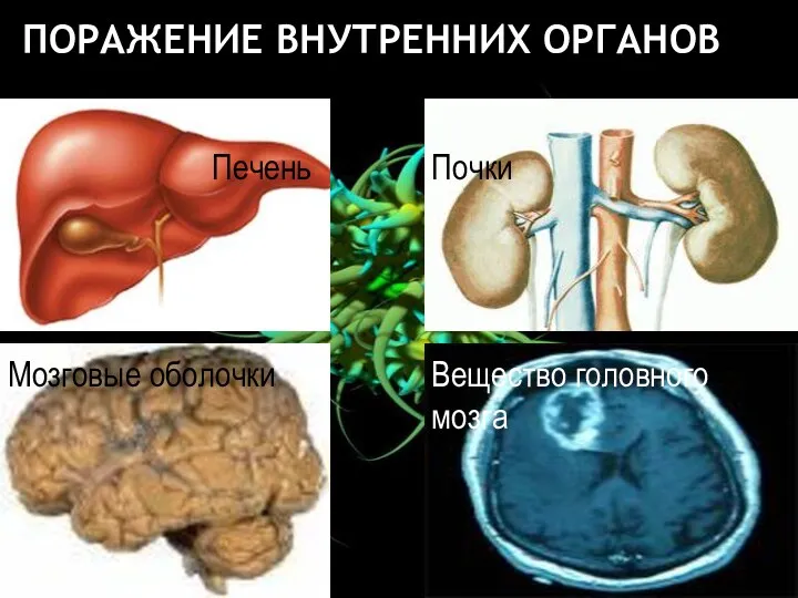 ПОРАЖЕНИЕ ВНУТРЕННИХ ОРГАНОВ Печень Почки Мозговые оболочки Вещество головного мозга