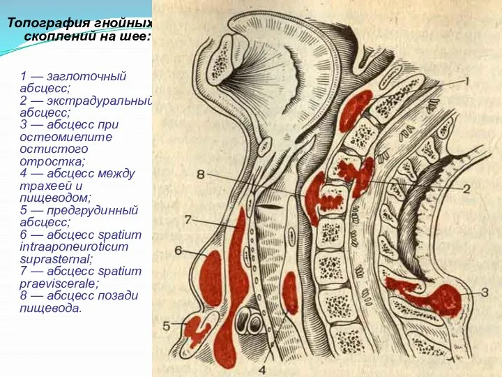 Топография гнойных скоплений на шее: 1 — заглоточный абсцесс; 2 — экстрадуральный абсцесс;