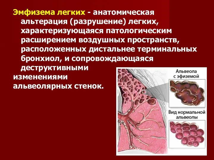 Эмфизема легких - анатомическая альтерация (разрушение) легких, характеризующаяся патологическим расширением