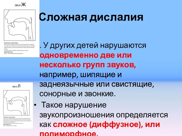 Сложная дислалия . У других детей нарушают­ся одновременно две или