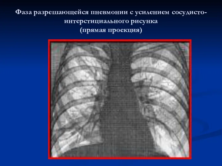 Фаза разрешающейся пневмонии с усилением сосудисто-интерстициального рисунка (прямая проекция)