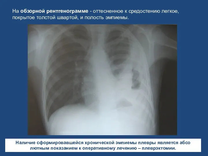 На обзорной рентгенограмме - оттесненное к средостению легкое, покрытое тол­стой швартой, и полость
