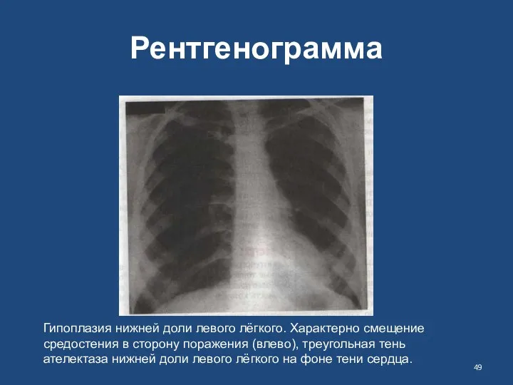 Рентгенограмма Гипоплазия нижней доли левого лёгкого. Характерно смещение средостения в