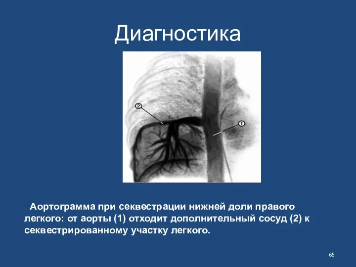 Диагностика Аортограмма при секвестрации нижней доли правого легкого: от аорты (1) отходит дополнительный