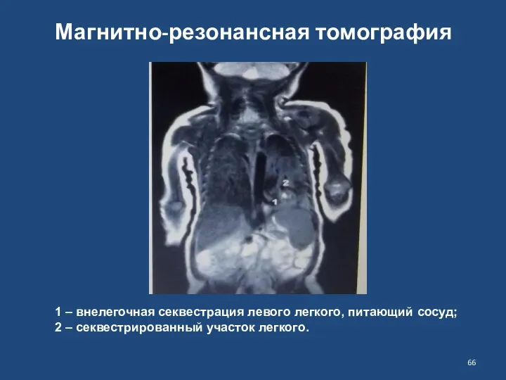 Магнитно-резонансная томография 1 – внелегочная секвестрация левого легкого, питающий сосуд; 2 – секвестрированный участок легкого.