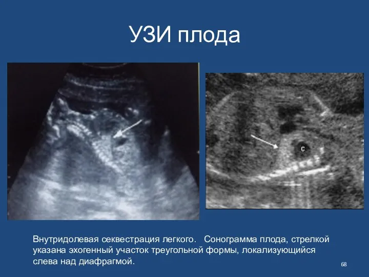 УЗИ плода Внутридолевая секвестрация легкого. Сонограмма плода, стрелкой указана эхогенный участок треугольной формы,