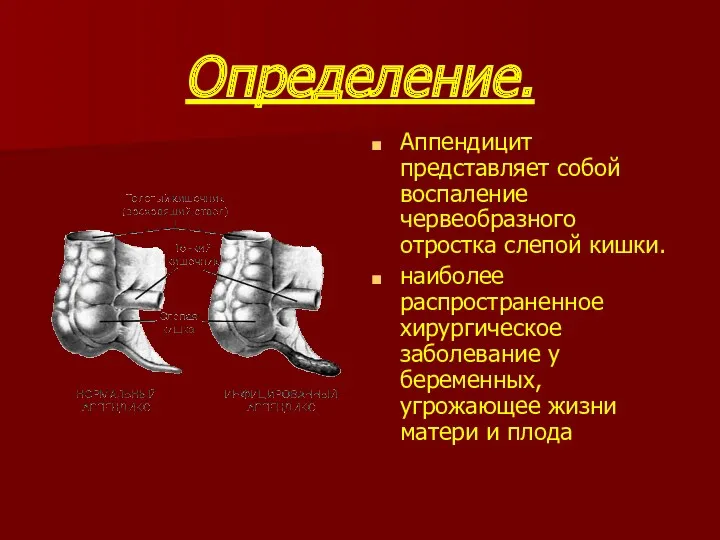 Определение. Аппендицит представляет собой воспаление червеобразного отростка слепой кишки. наиболее