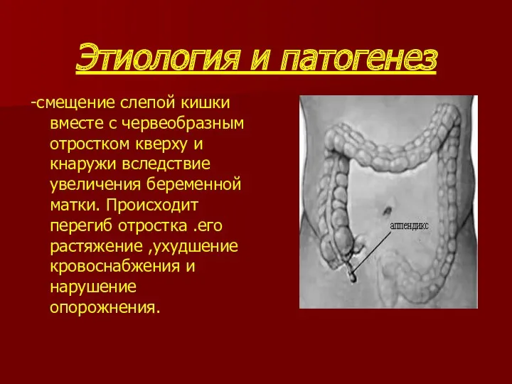 Этиология и патогенез -смещение слепой кишки вместе с червеобразным отростком