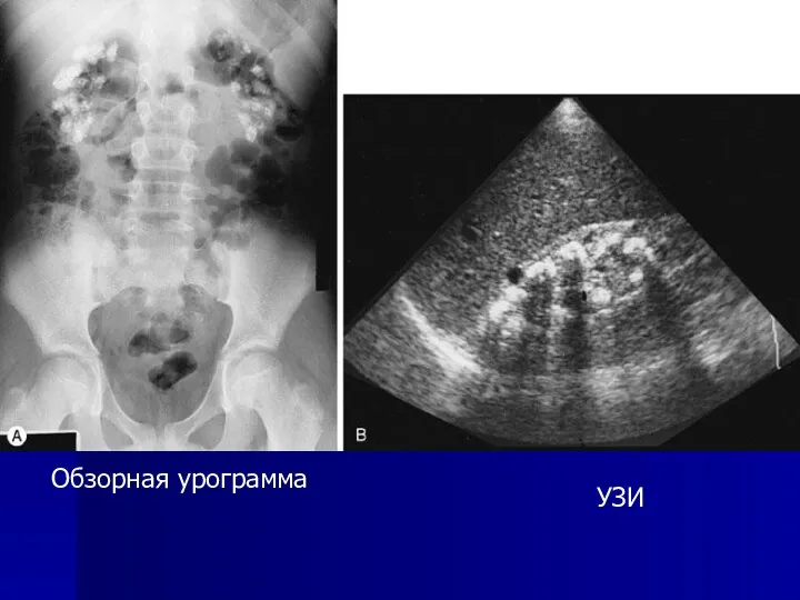 УЗИ Обзорная урограмма