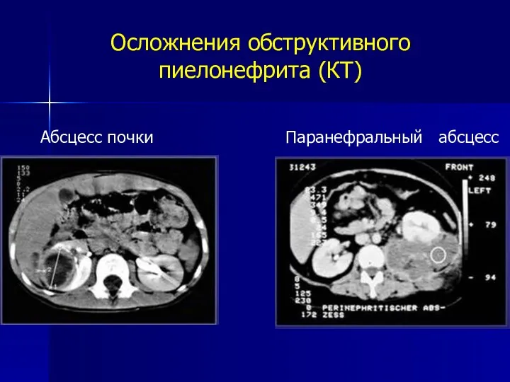 Осложнения обструктивного пиелонефрита (КТ) Абсцесс почки Паранефральный абсцесс
