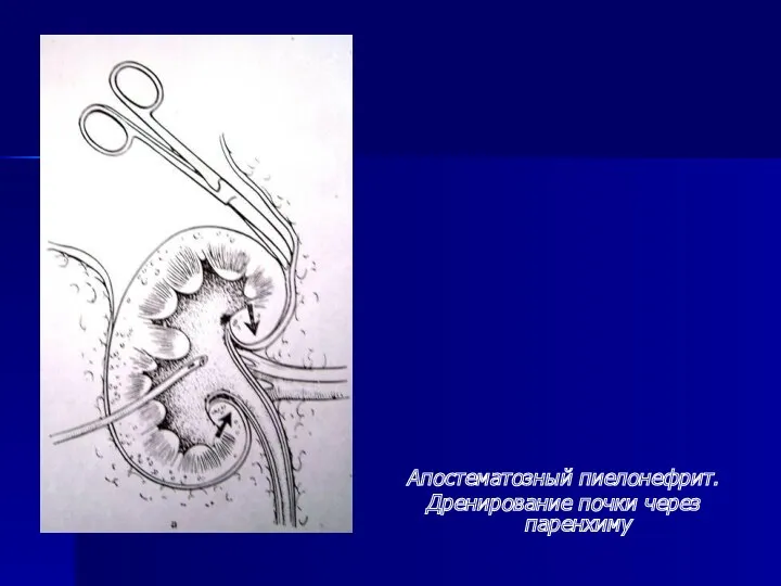 Апостематозный пиелонефрит. Дренирование почки через паренхиму