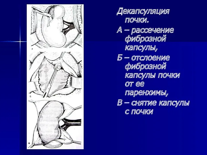 Декапсуляция почки. А – рассечение фиброзной капсулы, Б – отслоение