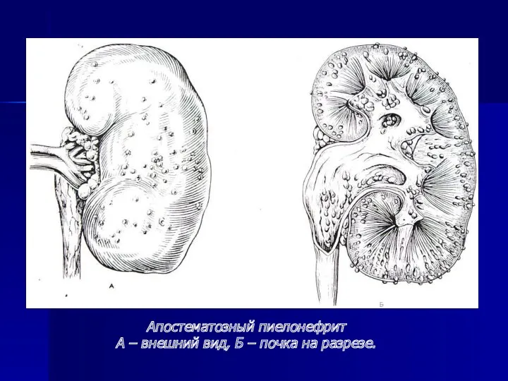 Апостематозный пиелонефрит А – внешний вид, Б – почка на разрезе.