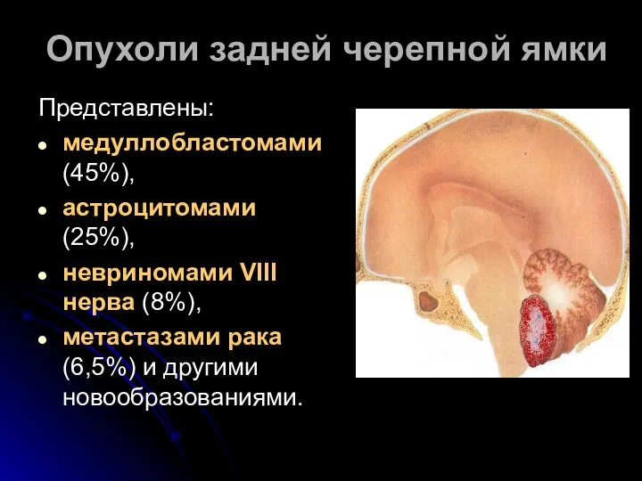 Опухоли задней черепной ямки Представлены: медуллобластомами (45%), астроцитомами (25%), невриномами