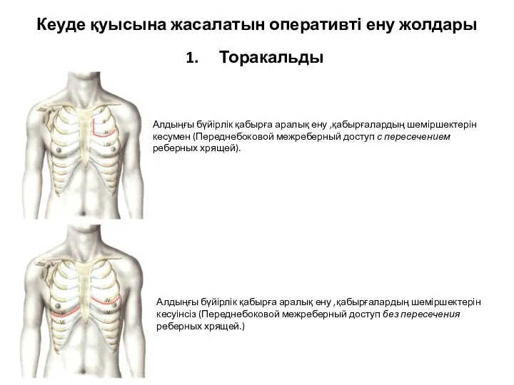 Кеуде қуысына жасалатын оперативті ену жолдары Торакальды Алдыңғы бүйірлік қабырға