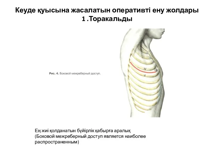 Кеуде қуысына жасалатын оперативті ену жолдары 1 .Торакальды Ең жиі