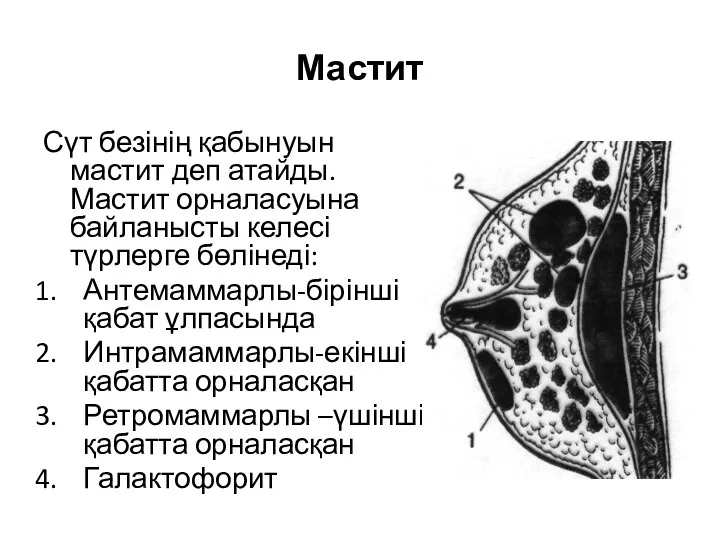 Мастит Сүт безінің қабынуын мастит деп атайды.Мастит орналасуына байланысты келесі