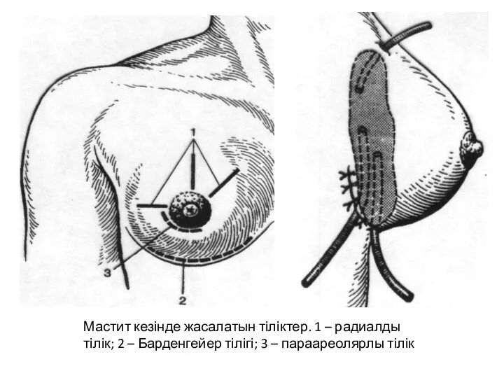 Мастит кезінде жасалатын тіліктер. 1 – радиалды тілік; 2 – Барденгейер тілігі; 3 – параареолярлы тілік