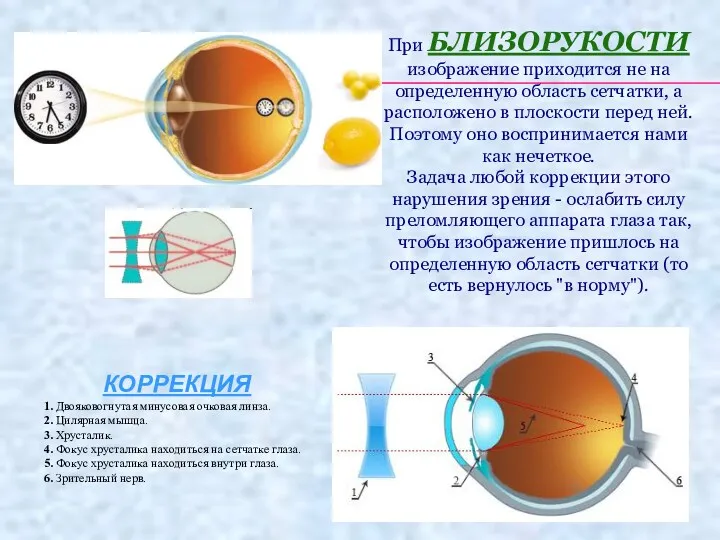 При БЛИЗОРУКОСТИ изображение приходится не на определенную область сетчатки, а