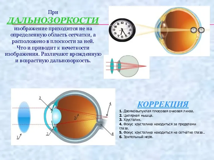 При ДАЛЬНОЗОРКОСТИ изображение приходится не на определенную область сетчатки, а