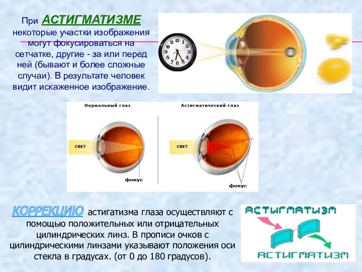 При АСТИГМАТИЗМЕ некоторые участки изображения могут фокусироваться на сетчатке, другие