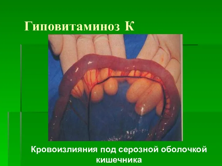 Гиповитаминоз К Кровоизлияния под серозной оболочкой кишечника