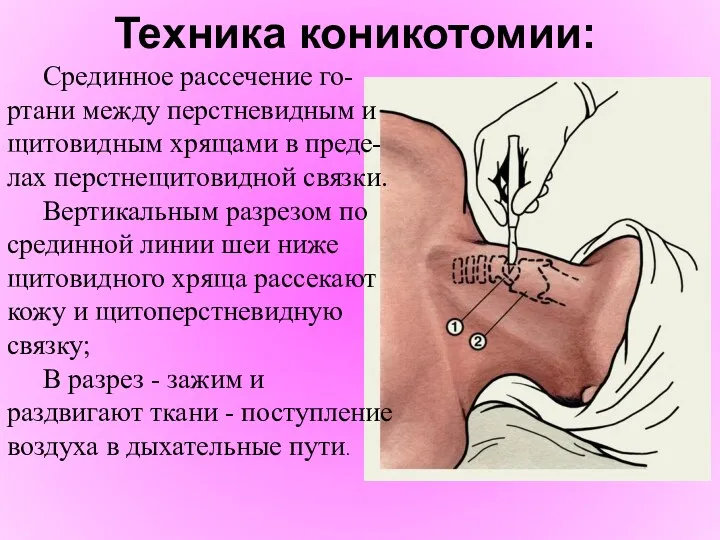 Техника коникотомии: Срединное рассечение го-ртани между перстневидным и щитовидным хрящами