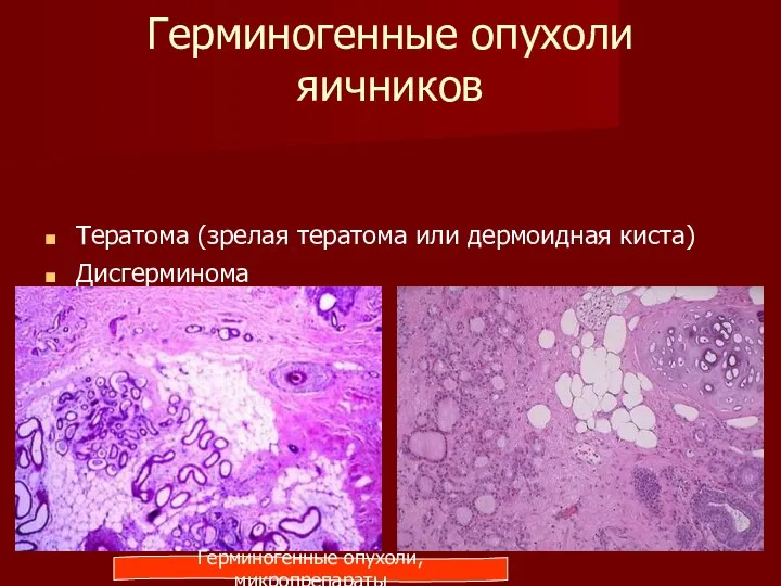Герминогенные опухоли яичников Тератома (зрелая тератома или дермоидная киста) Дисгерминома Герминогенные опухоли, микропрепараты