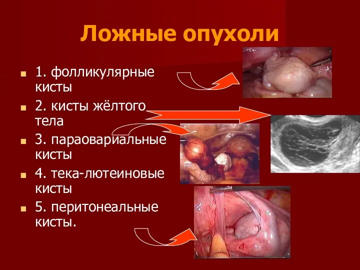 Ложные опухоли 1. фолликулярные кисты 2. кисты жёлтого тела 3.