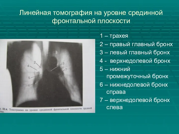 Линейная томография на уровне срединной фронтальной плоскости 1 – трахея 2 – правый