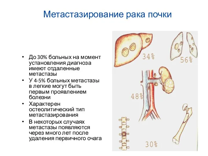 Метастазирование рака почки До 30% больных на момент установления диагноза имеют отдаленные метастазы