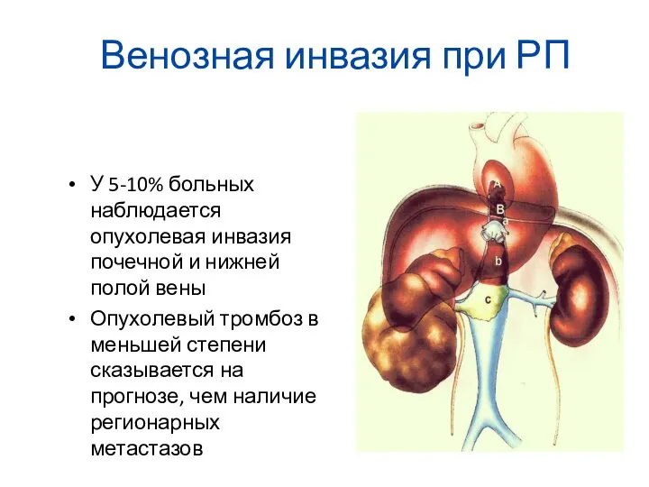 Венозная инвазия при РП У 5-10% больных наблюдается опухолевая инвазия