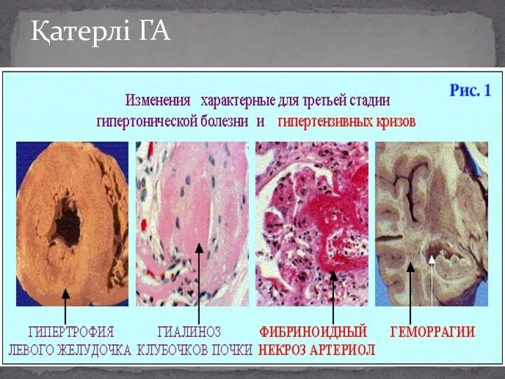 Қатерлі ГА