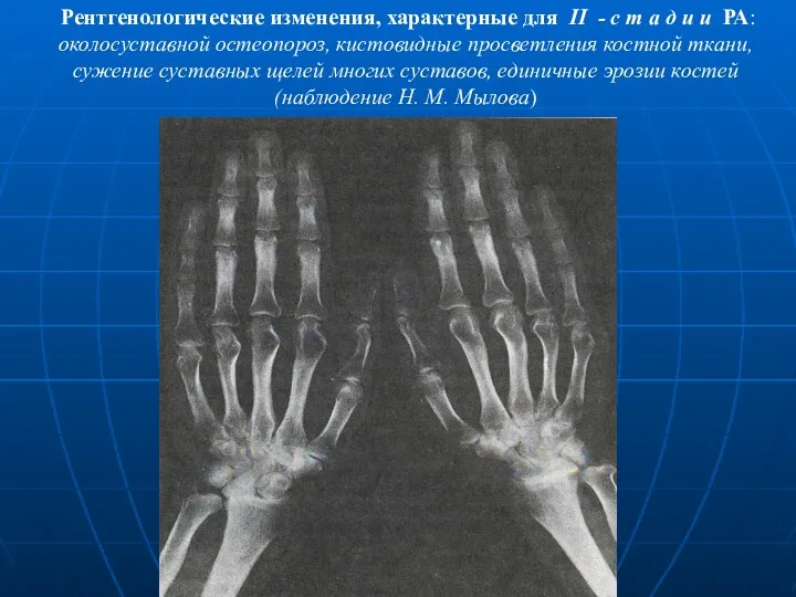 Рентгенологические изменения, характерные для II - с т а д