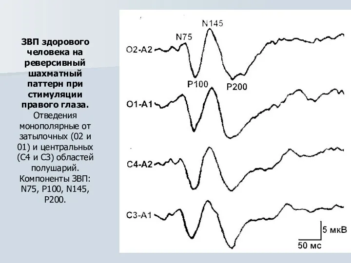ЗВП здорового человека на реверсивный шахматный паттерн при стимуляции правого