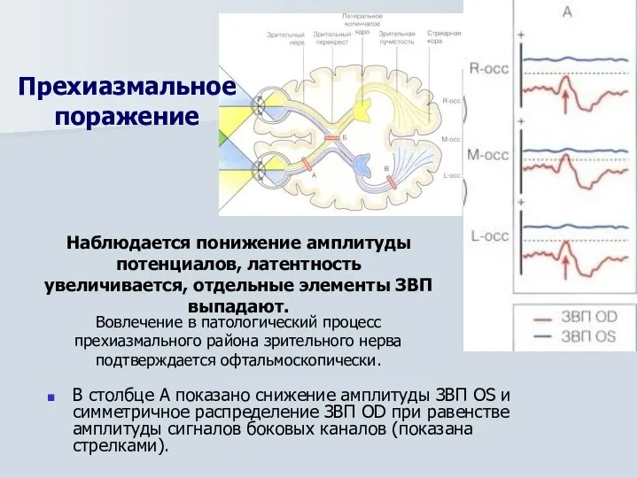 В столбце А показано снижение амплитуды ЗВП OS и симметричное