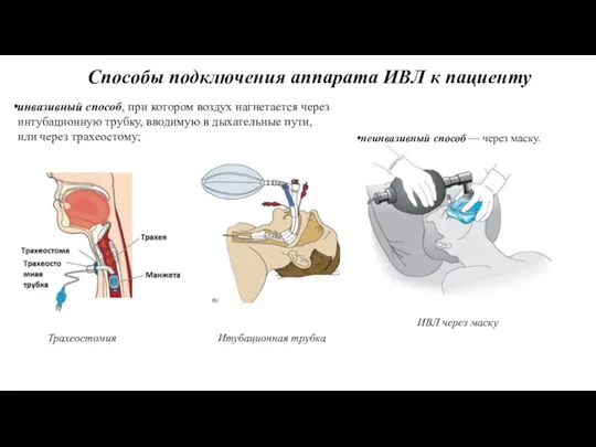 неинвазивный способ — через маску. Способы подключения аппарата ИВЛ к