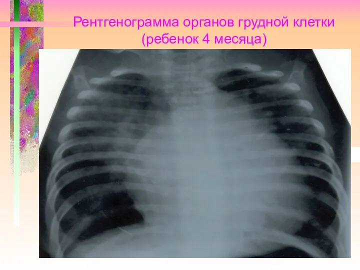 Рентгенограмма органов грудной клетки (ребенок 4 месяца)