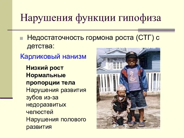 Нарушения функции гипофиза Недостаточность гормона роста (СТГ) с детства: Карликовый