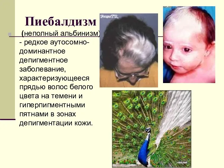 Пиебалдизм (неполный альбинизм) - редкое аутосомно-доминантное депигментное заболевание, характеризующееся прядью