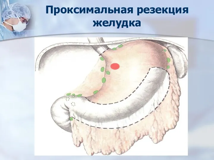 Проксимальная резекция желудка